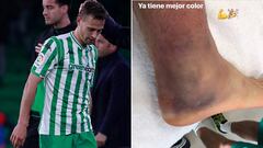 As&iacute; est&aacute; el tobillo de Canales antes del Betis-Sevilla.