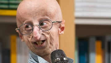 Muere la persona con progeria más longeva del mundo