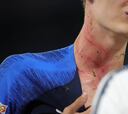 Así quedó el cuello de Pavard tras el pisotón de Rüdiger
