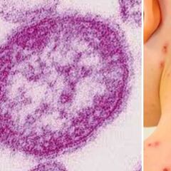 Emiten alerta por sarampión en México: cuántos casos hay, síntomas y cómo detectarlo a tiempo