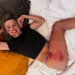 Niewiadoma enseña sus heridas de Strade Bianche: “Pudo haber sido peor”