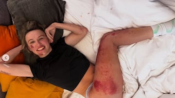 La ciclista polaca Kasia Niewiadoma posa con las heridas que sufrió tras su caída en la Strade Bianche