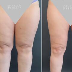 La enfermedad silenciosa que afecta a miles de mujeres en Chile: se confunde con la obesidad