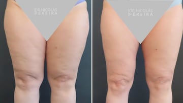 La enfermedad silenciosa que afecta a miles de mujeres en Chile: se confunde con la obesidad