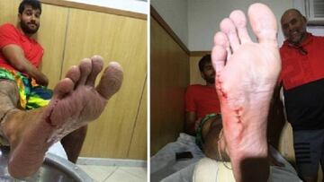 El corte en un pie que complica a Marco Grimalt antes de Río