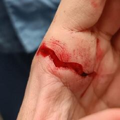 Un aficionado del Pedro Hidalgo B apuñala al entrenador del CD Firgas