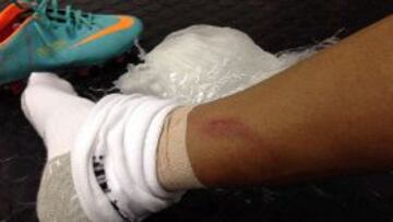 La imagen de la pierna de Neymar, con la marca de la bota de Rom&aacute;n.
