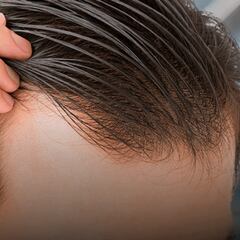 El boom de implantes de pelo llega a Chile: cuánto cuesta y cuáles son los resultados