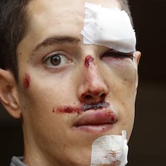 "Fue una caída tonta, pero la consecuencia fue brutal"