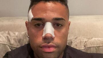 Mariano, delantero del Real Madrid, muestra el estado de su nariz tras ser intervenido quirúrgicamente.
