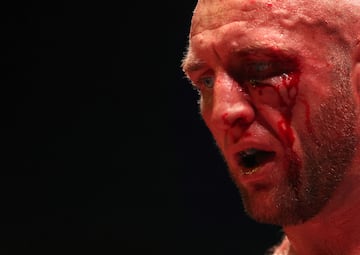 El BKB (Bare-knuckle boxing) es el deporte del boxeo sin el uso de guantes de boxeo u otro acolchado en las manos de los participantes.