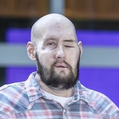 Completan el primer trasplante de ojo del mundo