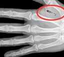 Proponen implantar microchips para combatir el dopaje
