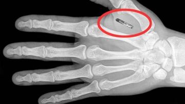 Proponen implantar microchips para combatir el dopaje