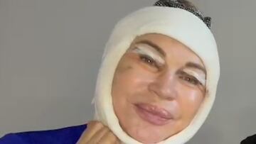 El irreconocible aspecto de Marlène Mourreau tras pasar por quirófano: “Parezco una momia”