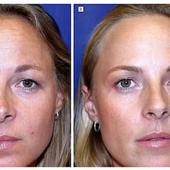 Una de las gemelas se pone bótox con regularidad y la otra no: así están las dos pasados unos años