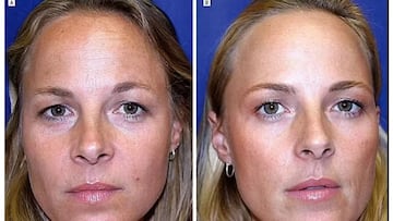 Una de las gemelas se pone bótox con regularidad y la otra no: así están las dos pasados unos años