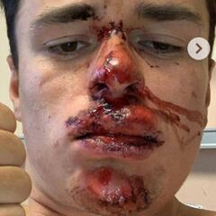 Pidcock abandona en el Tour del Porvenir por una dura caída