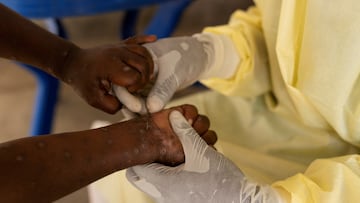 MPOX: Suecia confirma primer caso de cepa mortal fuera de África