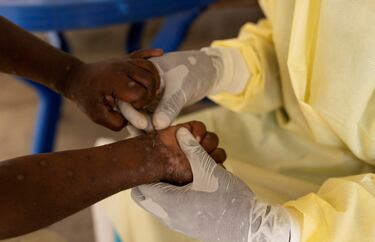 OMS declara brote de Mpox (viruela del mono) como emergencia sanitaria: qué es y cuáles son los síntomas 