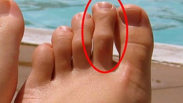 ¿Tienes este dedo del pie más largo? ¡Pues ten cuidado!
