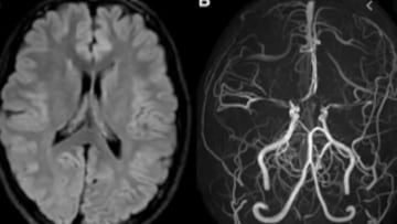 El vecino de España alerta de la rara enfermedad ‘nube de humo’: estos son los que corren mayor riesgo