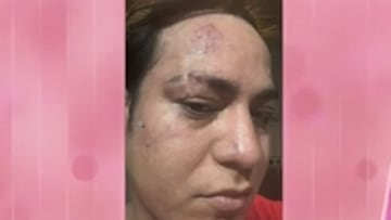 Valeri, la examante de Álvaro Escassi, víctima de una agresión en su casa tras sufrir un intento de atropello