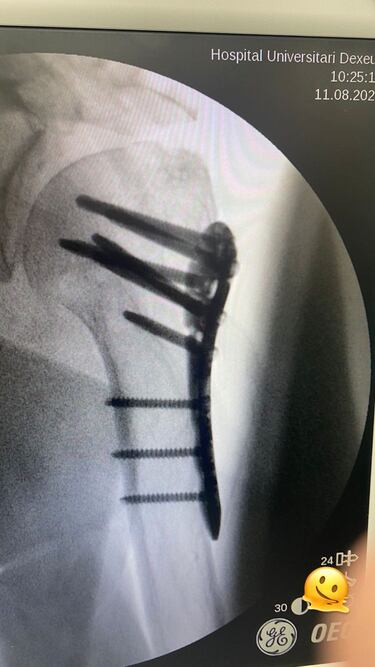 Mercedes Milá, tras ser operada por su accidente: “Se encontró una ‘avería’ muy seria”