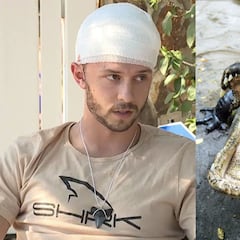 Sobrevive milagrosamente a un ataque de caimán que le mordió en la cabeza