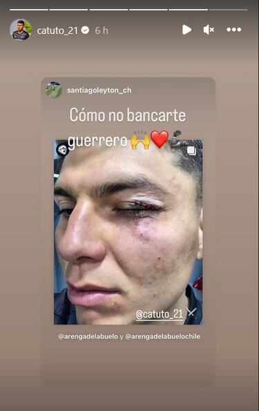 Rebolledo muestra cómo le quedó el rostro tras brutal puñetazo