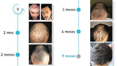 ?ltima moda contra la alopecia: injerto capilar en Turqua