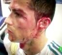 Espeluznante: Cristiano mostró su herida en el vestuario tras el golpe