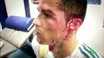 Espeluznante: Cristiano mostró su herida en el vestuario tras el golpe