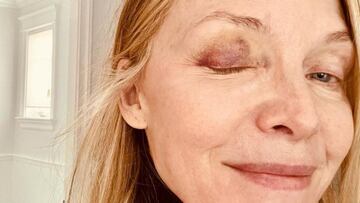 Michelle Pfeiffer sorprende con el estado de su cara tras un accidente doméstico