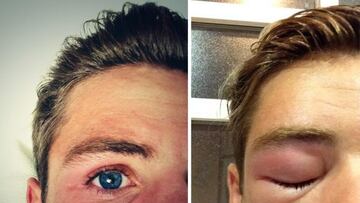 Así quedó el ojo de Bautista, tras la picadura de una abeja