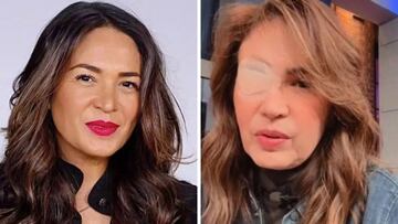 Cuál es la extraña enfermedad que padece Yolanda Andrade