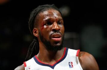 DeMarre Carroll terminó con una brecha ante los Raptors.