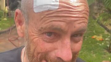 Tom Carroll con una venda en la cabeza