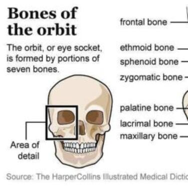 Rose, fractura del orbital del ojo y de vuelta al quirófano