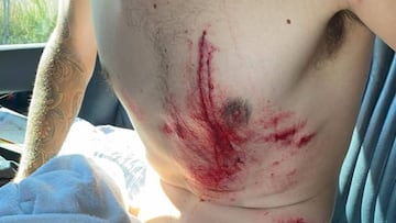 El ciclista &Aacute;ngel Madrazo muestra las heridas que sufri&oacute; tras una ca&iacute;da en la Settimana Internazionale Coppi e Bartali.
