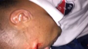 El defensor del DIM sufrió un impacto en el rostro después de que un grupo de personas atacara con piedras el bus en donde se movilizaban los jugadores del equipo antioqueño.
