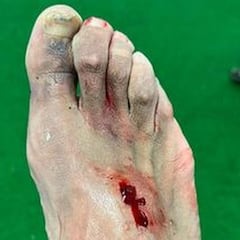 Akapo, dos meses de baja tras la entrada de Hazard