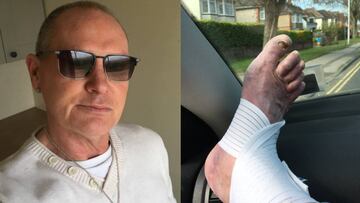 Gascoigne muestra su lesión... y sus seguidores se fijan en sus uñas.