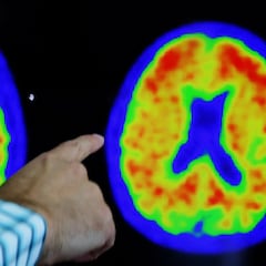 Un médico estadounidense detalla cuatro signos del Alzhéimer que se manifiestan décadas antes de sufrir la enfermedad