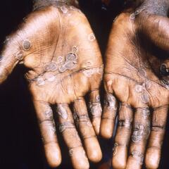 What are the early symptoms of monkeypox?