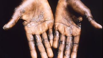 The palms of a monkeypox case patient from Lodja, a city located within the Katako-Kombe Health Zone, are seen during a health investigation in the Democratic Republic of Congo in 1997.