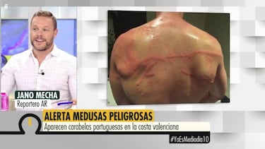 Un reportero explica cómo sufrió con la picadura de una carabela portuguesa