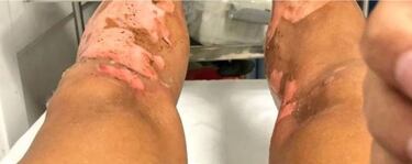 El grave accidente doméstico que sufrió ex jugador de Colo Colo