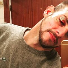 Álex Casademunt, víctima de una brutal agresión