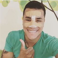 Jeison Murillo fue operado de la nariz con éxito